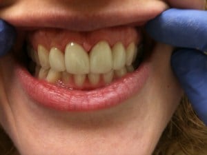 Woman's Smile After Dental Treatment Case #1.2