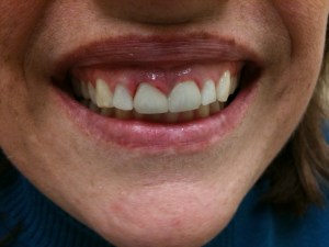 Woman's Smile After Dental Treatment Case #2.2