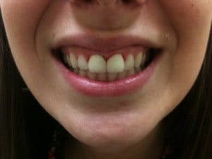 Woman's Smile After Dental Treatment Case #3.2