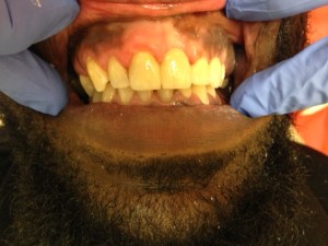 Man's Smile After Dental Treatment Case #4.2