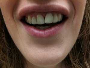 Woman's Smile Before Dental Treatment Case #1