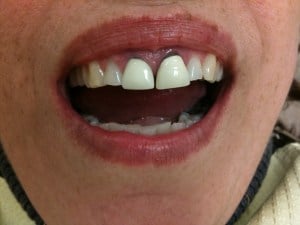 Woman's Smile Before Dental Treatment Case #2
