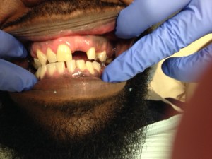 Man's Smile Before Dental Treatment Case #4