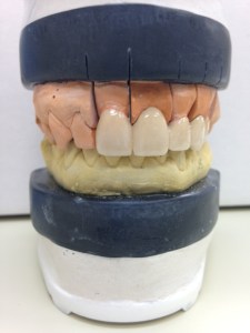 Dental impressions for Dental Implants