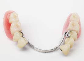 A lower mouth partial dentures